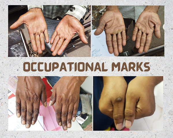 Occupational Marks A Tool For Personal Identification